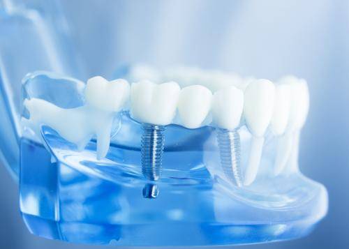 Clínica de implantes dentales Valencia Clínica de implantes dentales Valencia