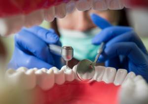 Clínica dental de endodoncias dentales Valencia profesional