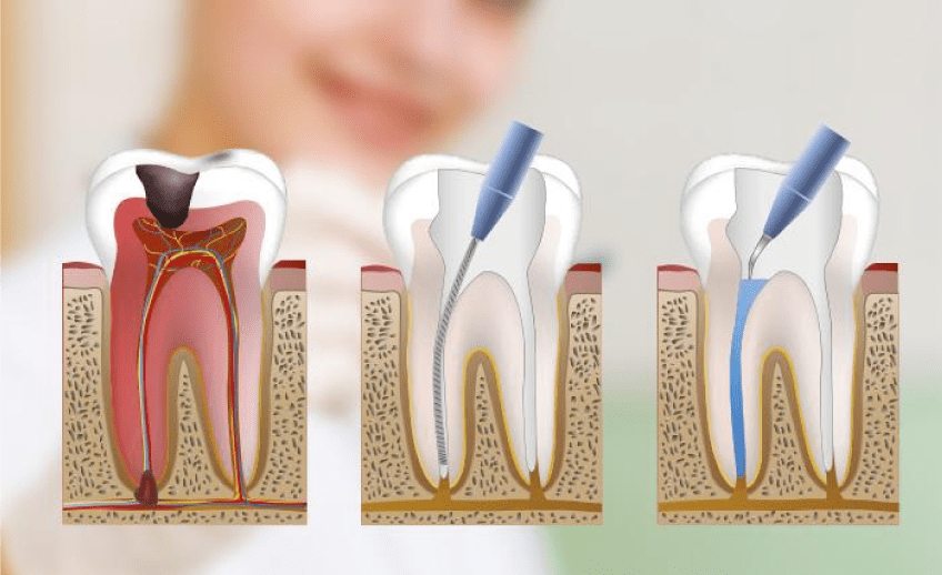 Clínica dental de endodoncias dentales Valencia