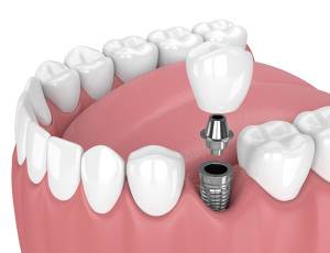 Implantes inmediatos Valencia