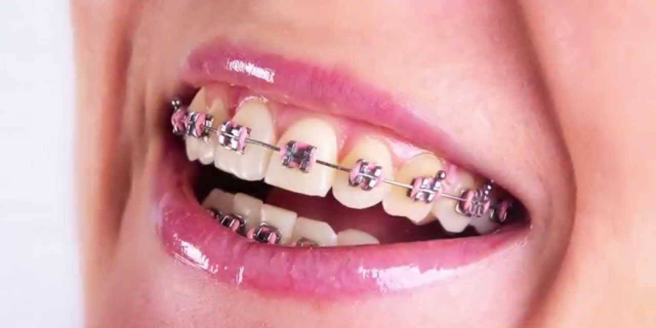 Ofertas ortodoncia Valencia