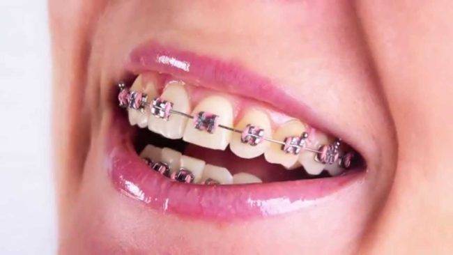 Ofertas ortodoncia Valencia Ofertas ortodoncia Valencia