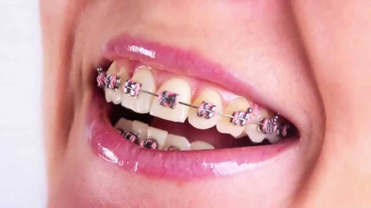 Ofertas ortodoncia Valencia Ofertas ortodoncia Valencia