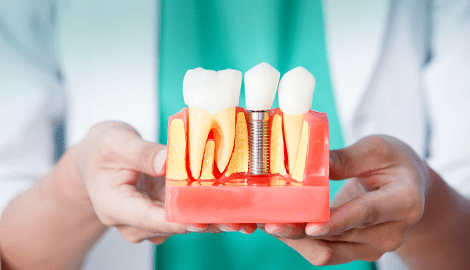 Realizamos tratamientos de implantología Valencia profesional Realizamos tratamientos de implantología Valencia profesional