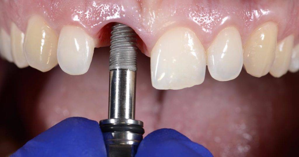 Mejor precio en implantes dentales Valencia