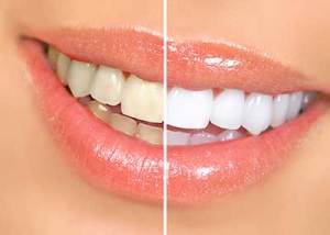 Tratamiento de blanqueamiento dental Valencia