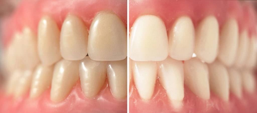 Tratamiento de blanqueamiento dental Valencia profesional