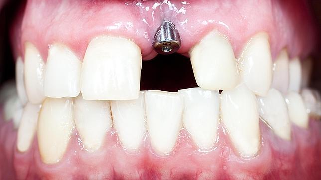 Implantes carga inmediata Valencia Implantes carga inmediata Valencia