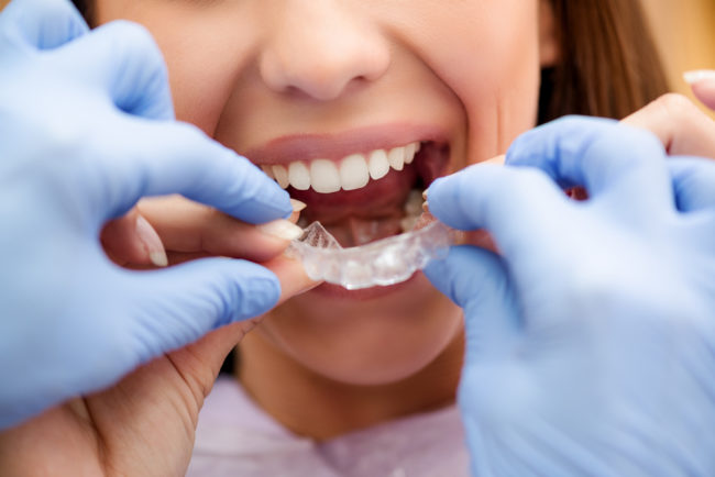 Clínica con tecnología invisalign Valencia Clínica con tecnología invisalign Valencia