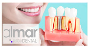 implantes clinica dental almar