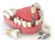 Implantes y dientes en el día Valencia